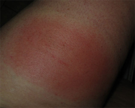 wasp sting on thigh